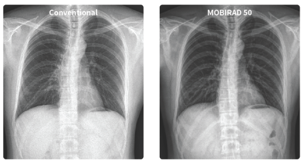 CI9JPJKO_8NCXR6SE Nexgencare Limited MOBIRAD 50 Digital Mobile X-Ray System