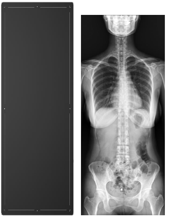 Nexgencare Limited Long Length Detector (LLD) Digital Radiography System